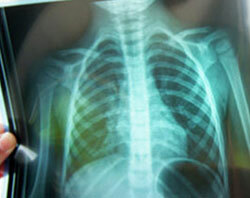 Diagnóstico de pneumonia, exame pulmonar