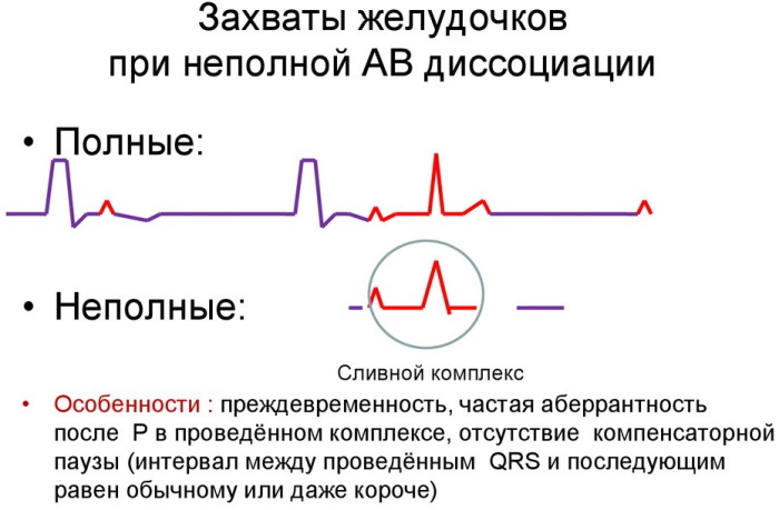 AV (atrioventricular) dissociation on the ECG. What does this mean, signs in a child, an adult