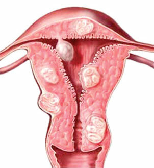 Nodular uterine fibroids: treatment and causes