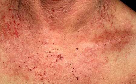 Allerginen dermatiitti aikuisilla ja lapsilla: hoito, valokuva