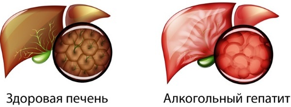 Toxic hepatitis. What is it, symptoms, treatment, clinical guidelines