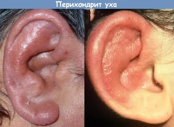 Ear tragus. Where is it, what is it, it hurts when pressed, inflamed, treatment