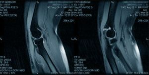 mrt van het kniegewricht voor artritis
