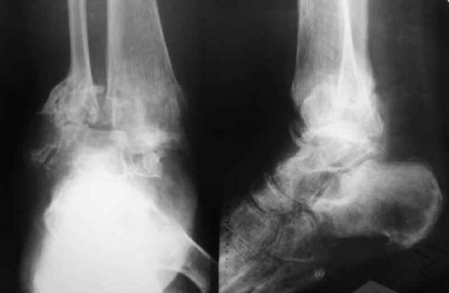 Röntgenfoto van de voet