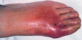 Foto de um pé afetada pela artrite artrítica clássica