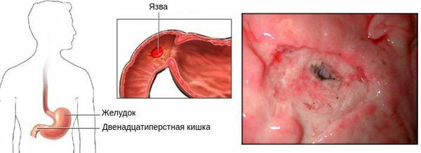 Bulbit. Symptoms and treatment in adults, what is it