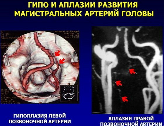 Hypoplasie de l'artère vertébrale droite. Qu'est-ce que c'est, symptômes, traitement