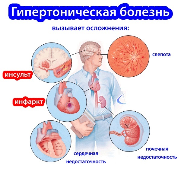 Øvelser for åreknuder på benene på arbejdet, under graviditeten, fra Bubnovsky, Lutsenko, Ostrovsky