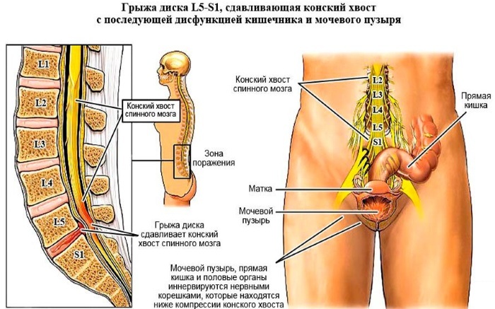 L5-S1 hernia. Where is a person, a photo, a diagram of the spine