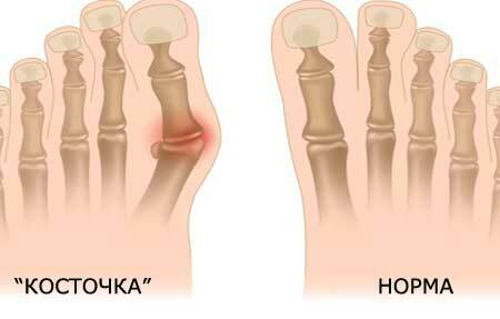 Kosti pri zdravljenju palca doma