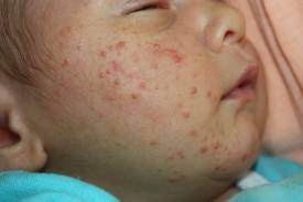 Alergie na tváři dítěte: léčba, fotografie, příznaky