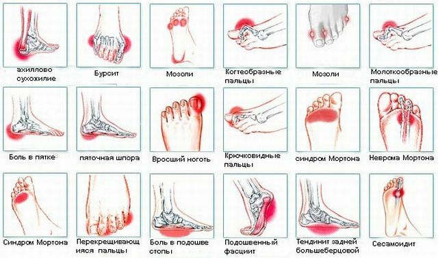 Causes of pain in the foot