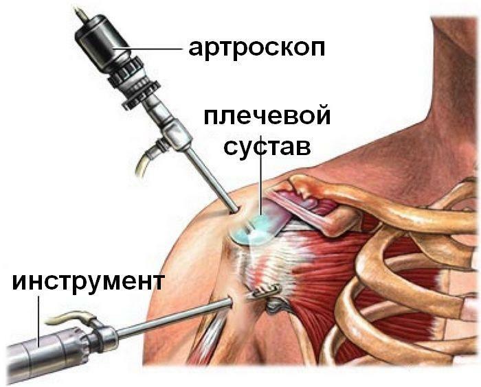 Artroscopía del hombro