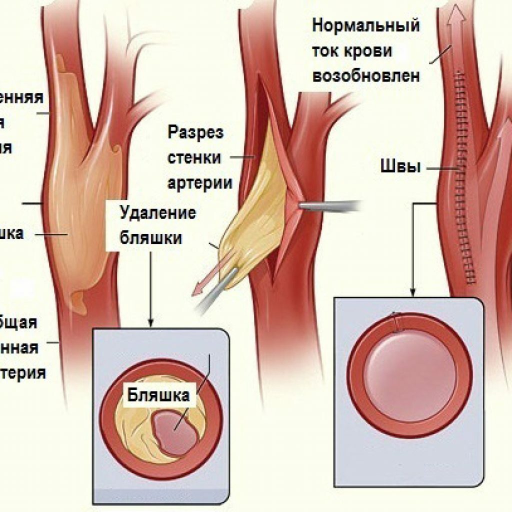 Endarterektomi şeması