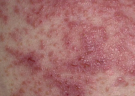Stages of wet eczema