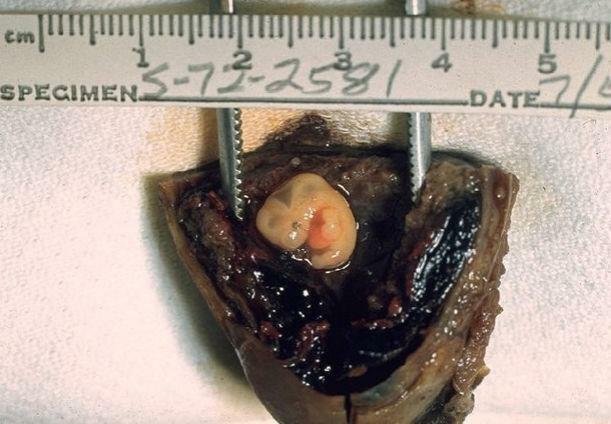Embrión de un embarazo ectópico