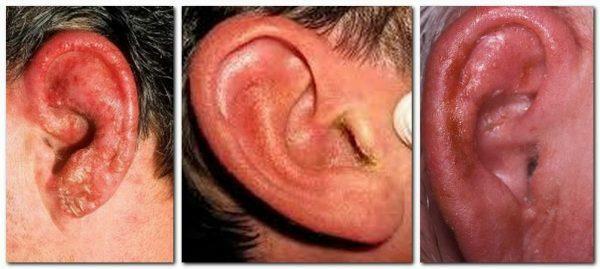 Pęcherzykowe zapalenie ucha środkowego: przyczyny, objawy, metody leczenia i zapobiegania