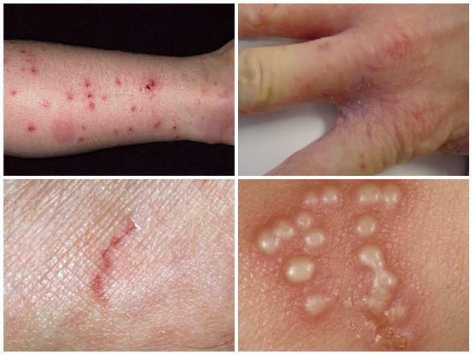 Scabies on human skin