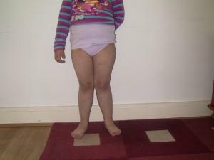Child with flat feet and foot deformities