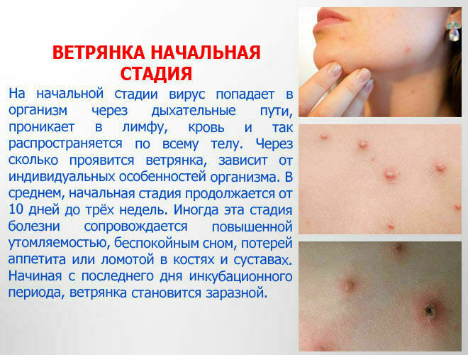 Chickenpox in adults. The first symptoms, how it begins, photo rash, how many days the temperature