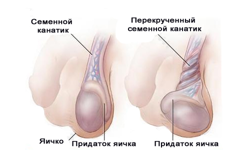 Torsie van de linker testikel