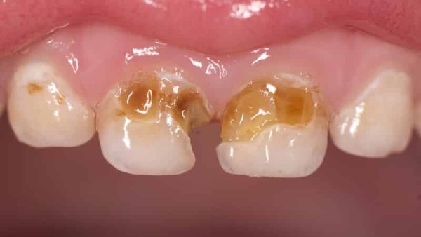 Bottle caries in children. Causes, symptoms, photos and treatment
