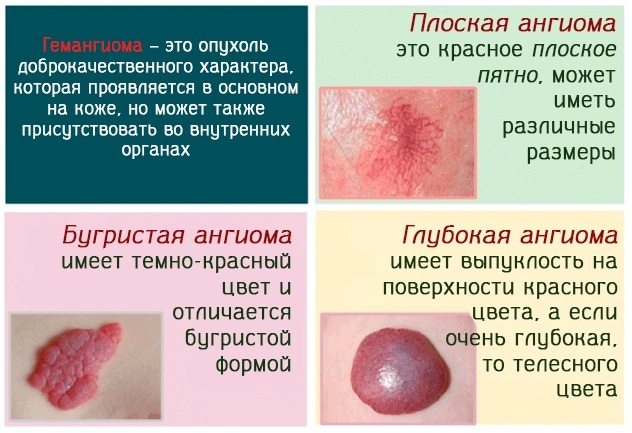 Skin Angioma. Bilde, symptomer og behandling. Folk rettsmidler, medisinert