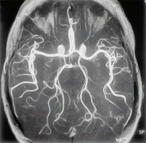 smegenų angiografija