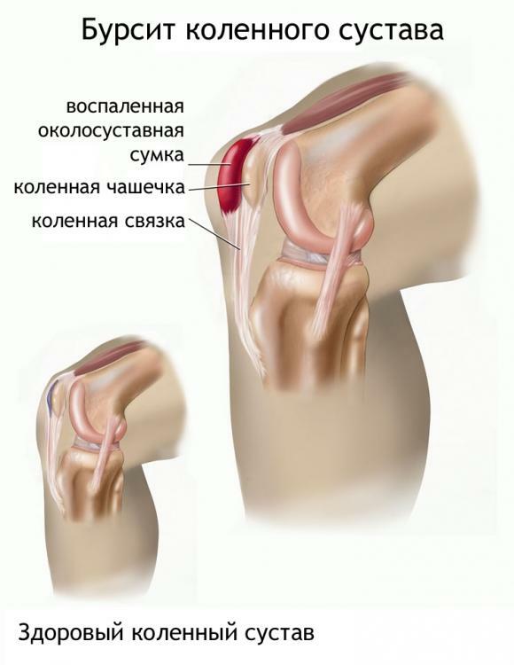 Bursite da articulação do joelho e articulações saudáveis