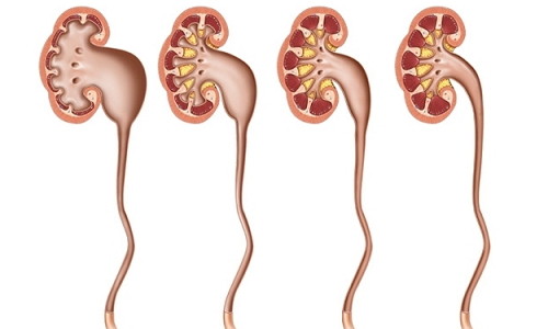 Stages of hydronephrosis