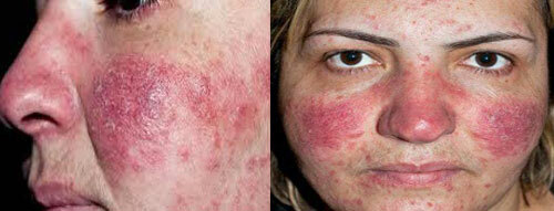 Treatment of rosacea on face