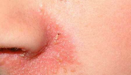 Seborrheic-dermatiitti
