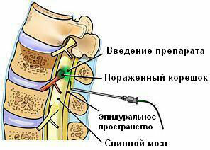 Epidural introduction of steroids
