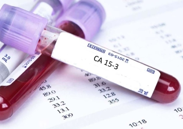 CA 15-3 tumor marker. Norm in women, table, what is it, decoding