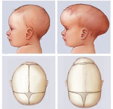 Kraniostenozė (craniosinostozė) vaikams ir suaugusiems. Kas tai yra, simptomai, klinikinės gairės