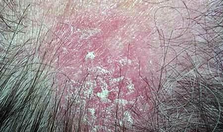 Spoty podobné lichenu na těle, ale NOT svědění( foto) - co to je?