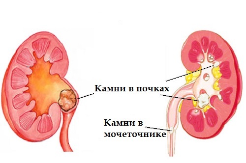 Doença de pedra renal e métodos de tratamento