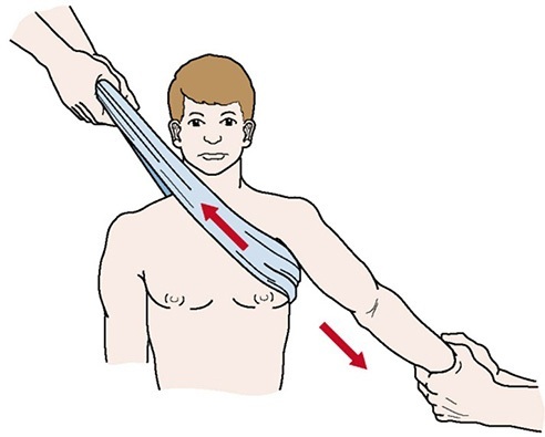 Dislocatie van het schoudergewricht. Behandeling, revalidatie, oefening, symptomen, eerste hulp, röntgen