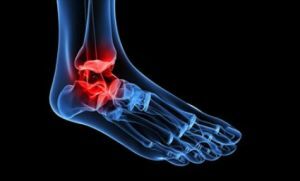 Kako odkriti in zdraviti artritis sklepov stopal v času?