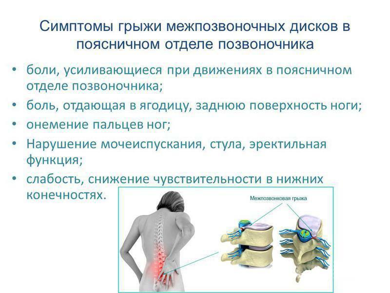 Symptoms of a herniated intervertebral disc in the lumbar spine