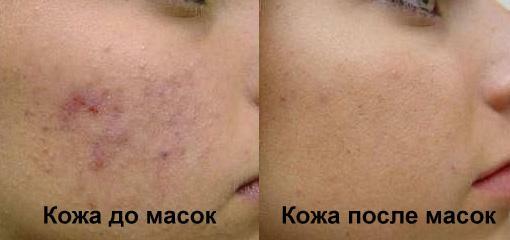 Before and after masks with aspirin