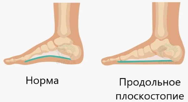 Vriststøtte til foden med flade fødder. Hvor kan man købe, hvordan man laver, vælger, pris, foto