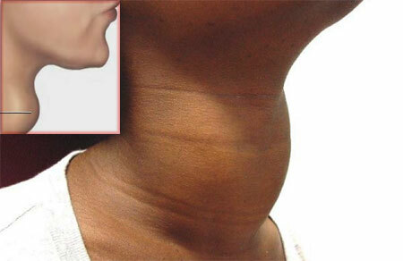 Diffuse toxic goiter - symptoms and treatment, degree of DTZ