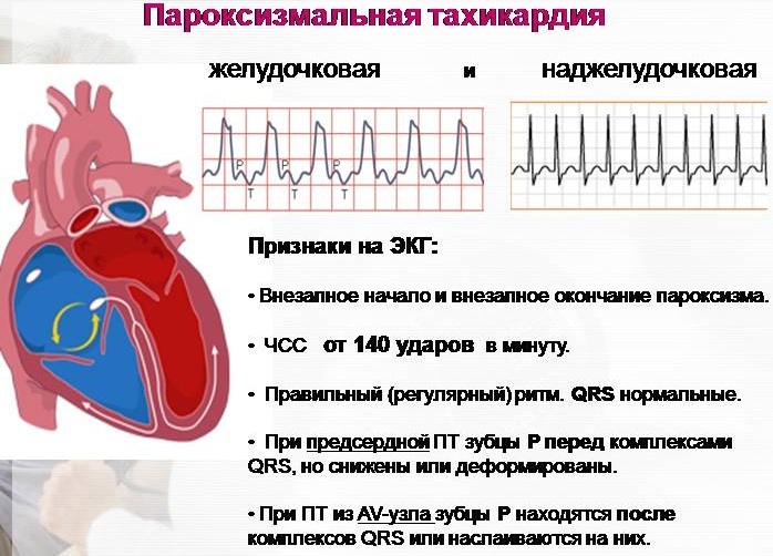 Violation of the rhythm of the heart. Causes, symptoms and treatment, what is it in children, clinical guidelines