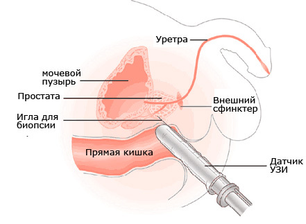 Como a ultra-sonografia da próstata é realizada?