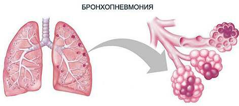Bronkopneumoni hos voksne. Symptomer, hva er det, behandling