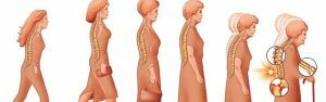 osteoporose hos kvinder