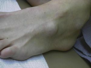 šľachový ganglion nohy