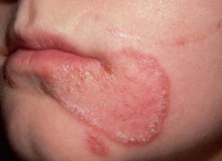 mycosis huid op gezicht foto