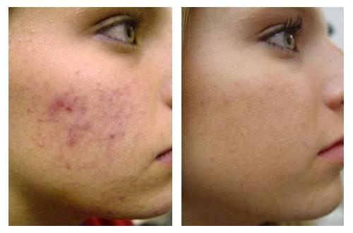 Before and after application of Zinerit